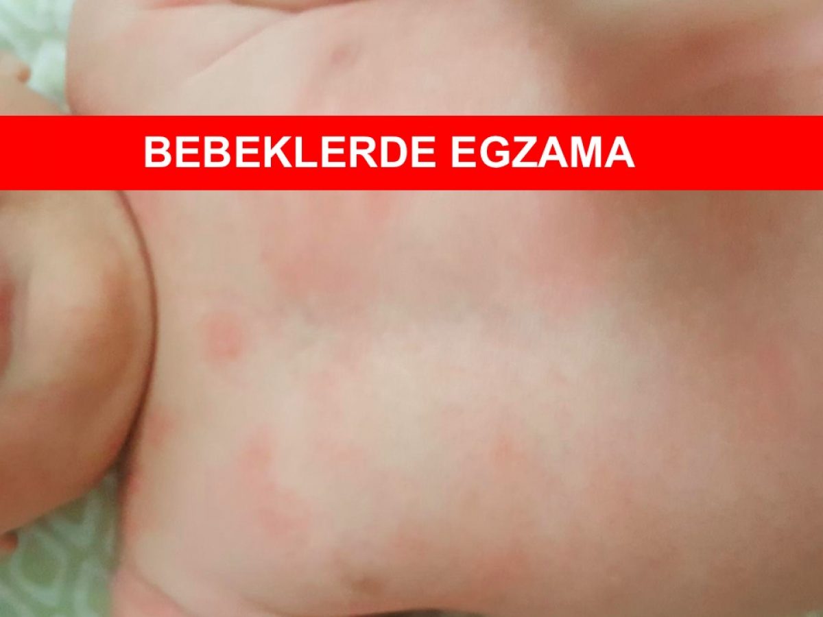 Egzama Tedavisi Belirtileri Hakkinda Bilgi Nedir